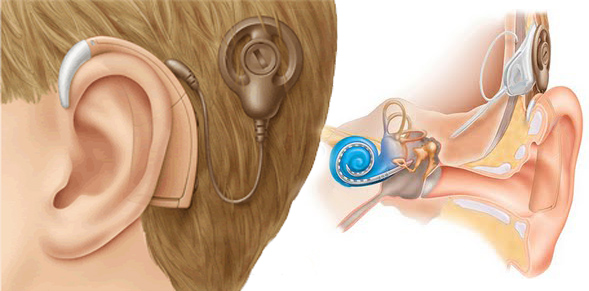 HGF realiza mais dois implantes cocleares