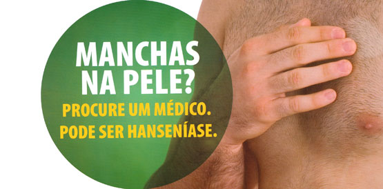 População é mobilizada para prevenir hanseníase