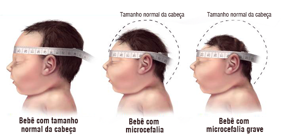 O que é microcefalia